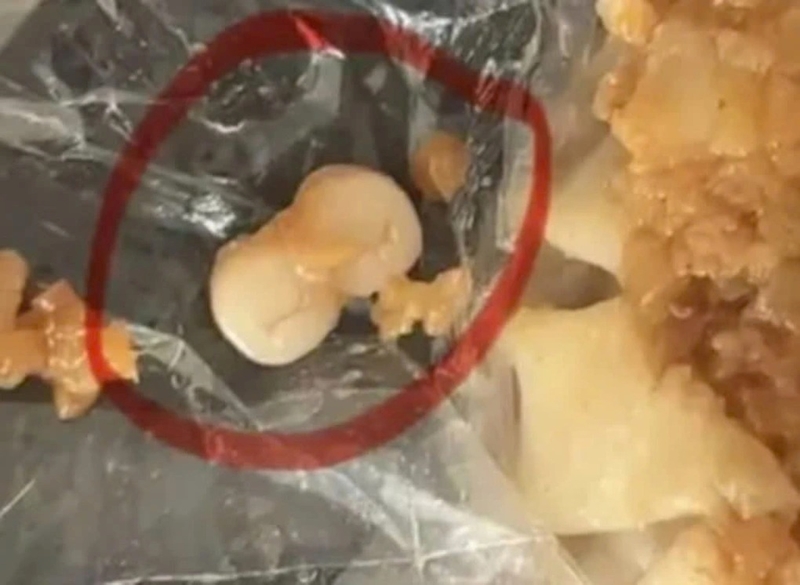 Liên tiếp các vụ phát hiện răng người trong đồ ăn gây xôn xao ở Trung Quốc