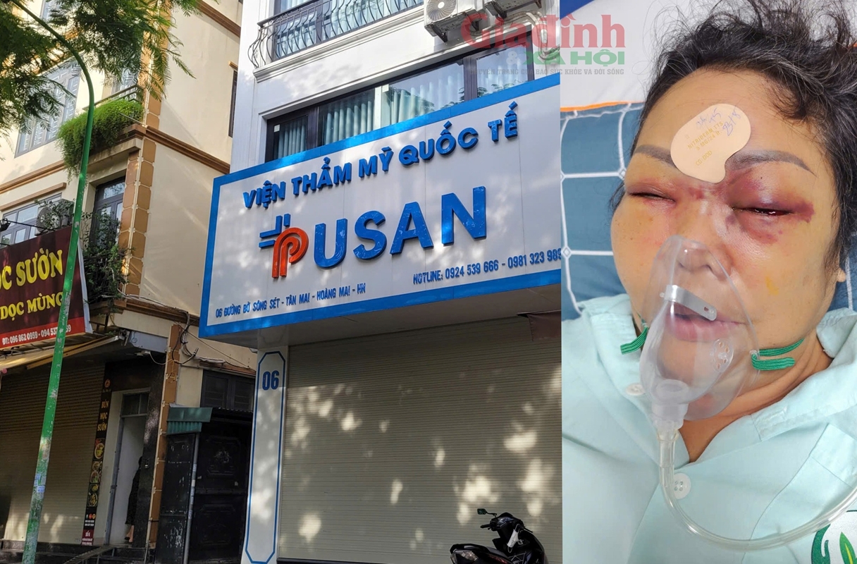 Nâng mũi cải vận nhận lại nỗi đau bài 3  Luật sư nói gì việc chối bỏ trách nhiệm sau tiêm filler gây mù mắt khách hàng